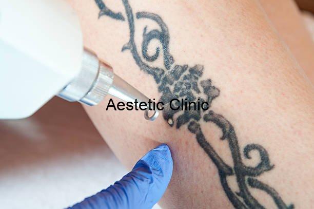 laserowe usuwanie tatuażu, błędy młodości tatuaże
