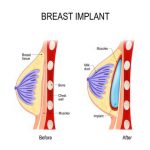 implanty piersi