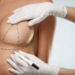 powiększanie piersi, sztuczne piersi, implanty piersi, duże cycki
