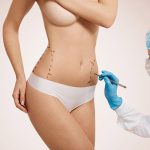 lipofilling, lipofilling biustu