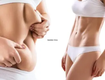 liposukcja, liposukcja NIL, odsysanie tłuszczu, liposukcja laserowa, liposukcja brzucha Poznań