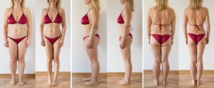 liposukcja przed i po