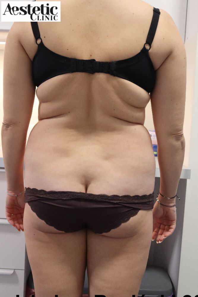 liposukcja przed