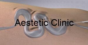 sclerosafe 2