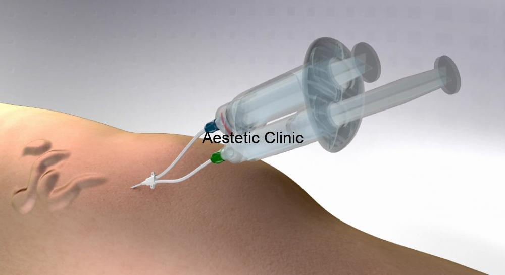 sclerosafe