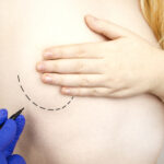lipofilling biustu