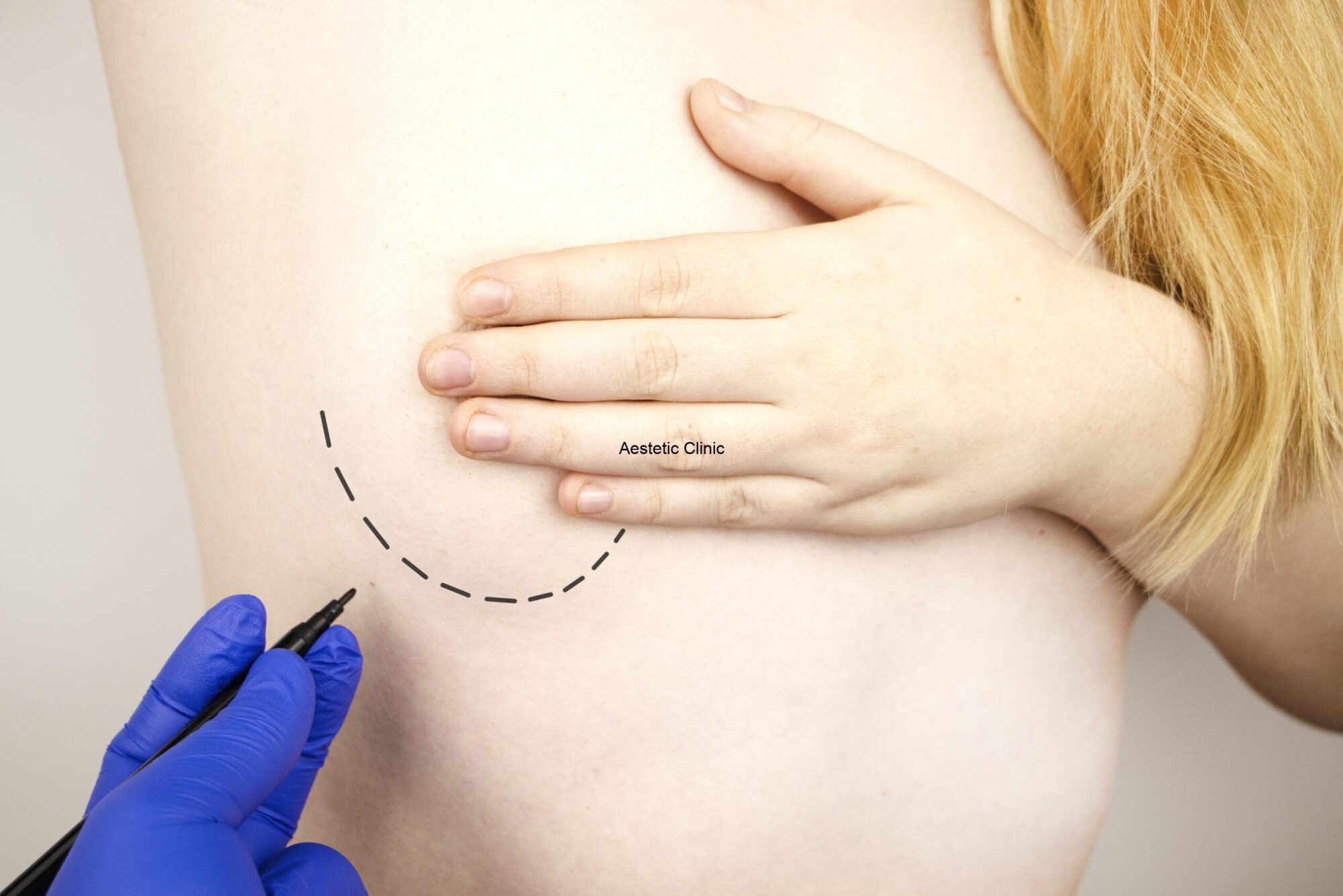 lipofilling biustu