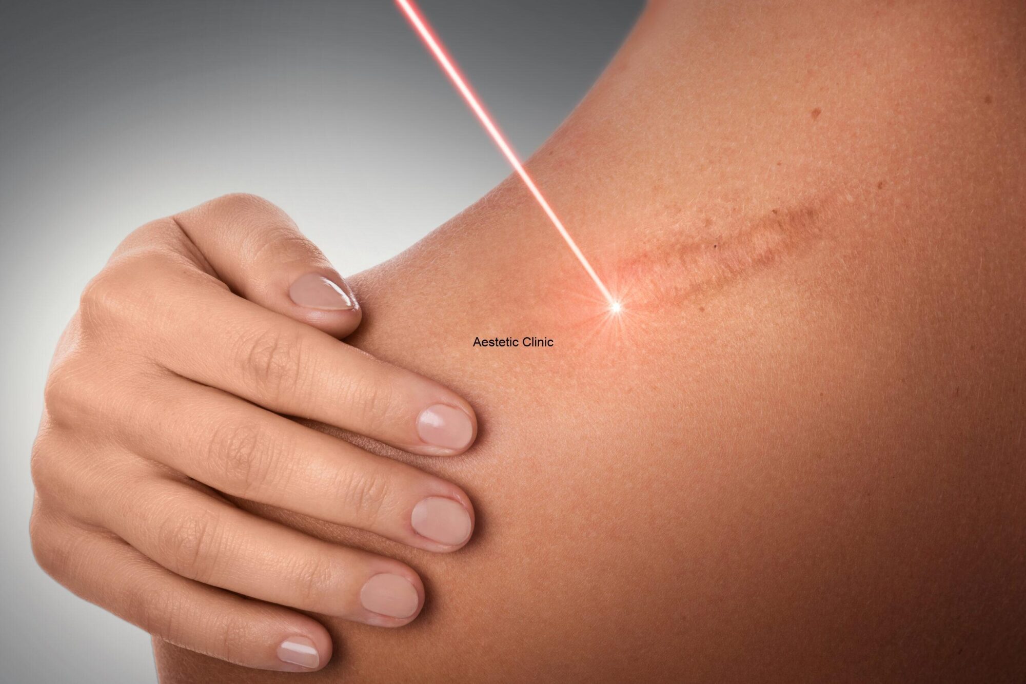 laserowe usuwanie blizn