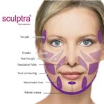 sculptra, Sculptra Poznań, kwas L-polimlekowy