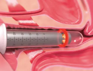 laserowe obkurczanie pochwy IntimaLase