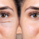 blepharoplastyka