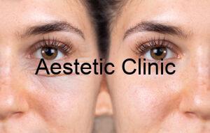 blepharoplastyka