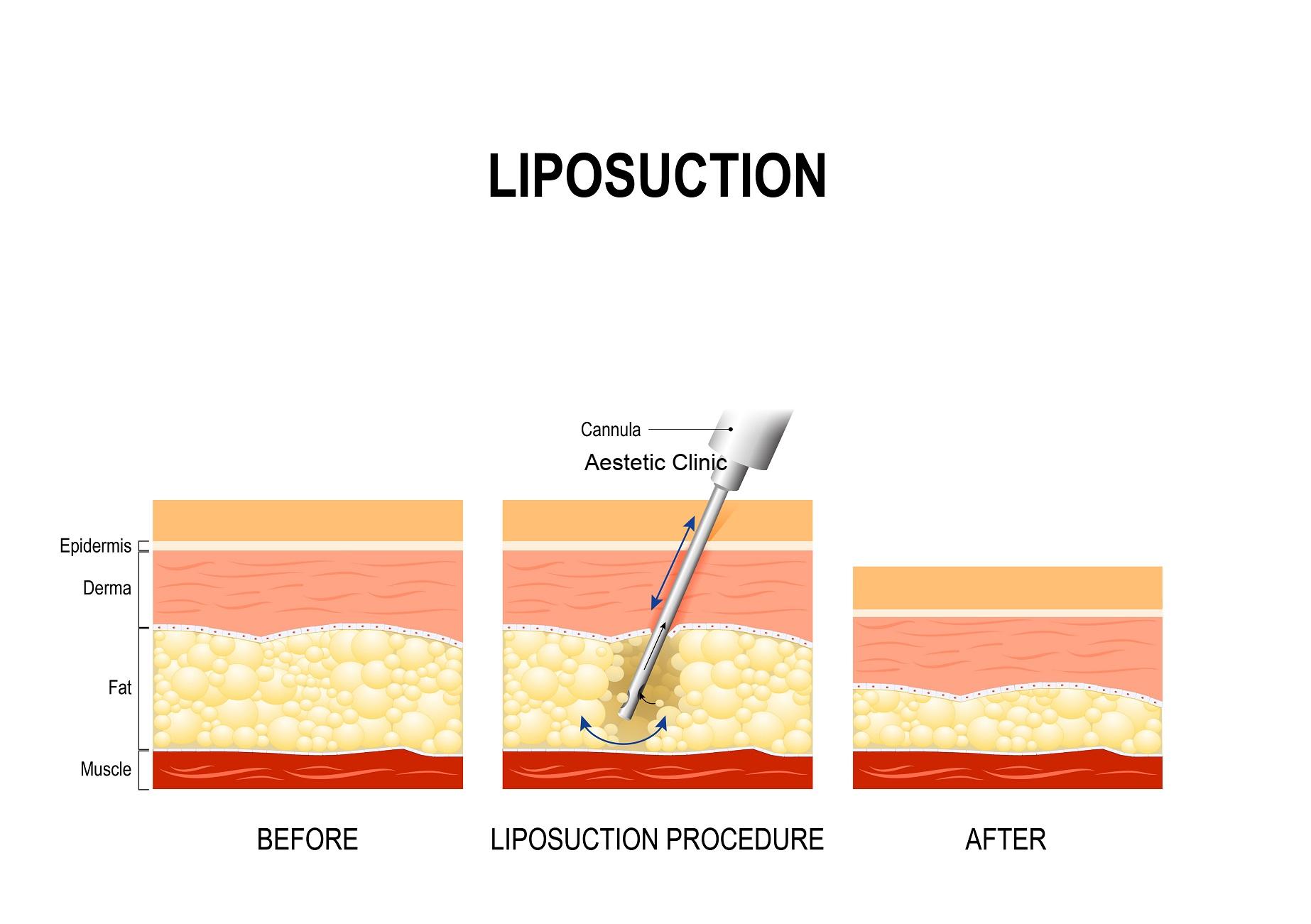 liposukcja ultradźwiękowa