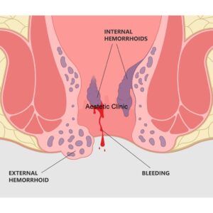 Co warto wiedzieć o hemoroidach