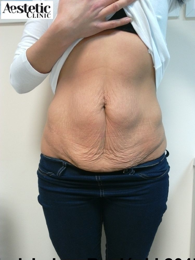 przed operacją obwisłego brzucha