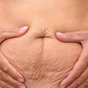 jak się pozbyć obwisłej skóry na brzuchu