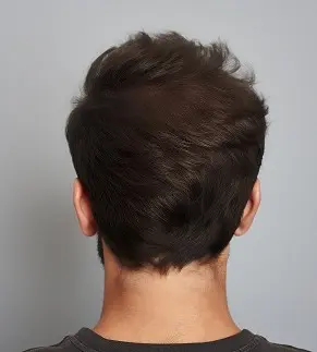 przeszczep włosów przed