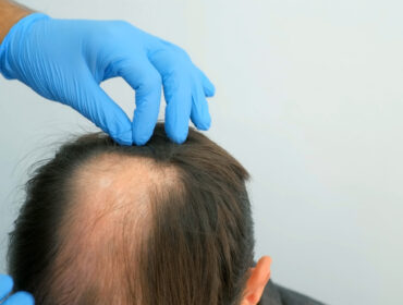 leczenie łysienia, Leczenie łysienia androgenowego Poznań