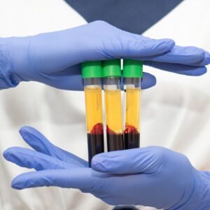 Czy warto robić zabieg osoczem na twarz?