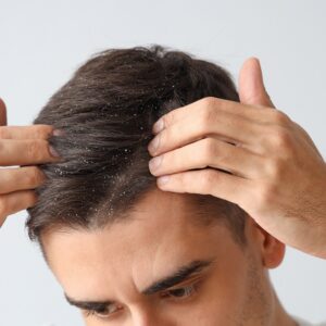 Jak się pozbyć łupieżu?