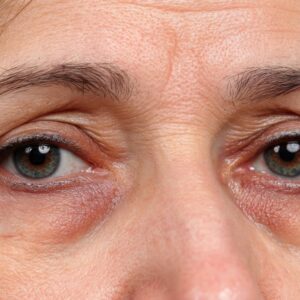 Jaki zabieg na worki pod oczami