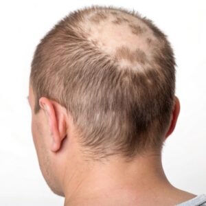 Najczęstsze choroby skóry głowy