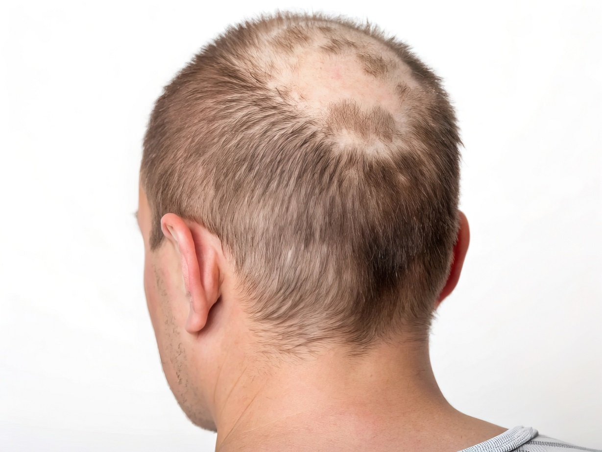 Najczęstsze choroby skóry głowy