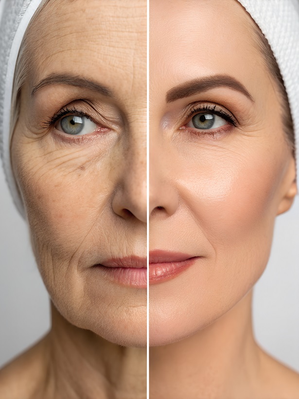 Blefaroplastyka dzień po dniu