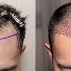 gojenie po przeszczepie włosów