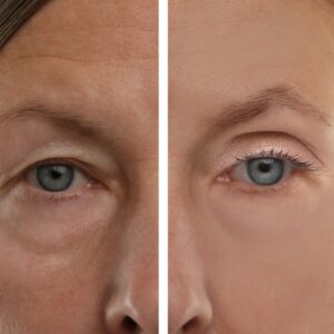 Blefaroplastyka górna vs dolna