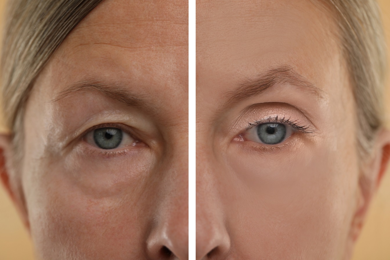 Blefaroplastyka górna vs dolna