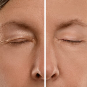 Masaż powiek po plastyce