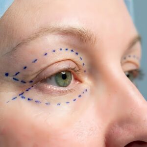 Jak wygląda rekonwalescencja po plastyce powiek