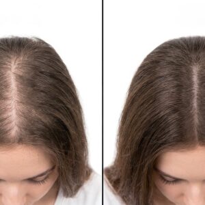 Minoxidil doustny w leczeniu wypadania włosów