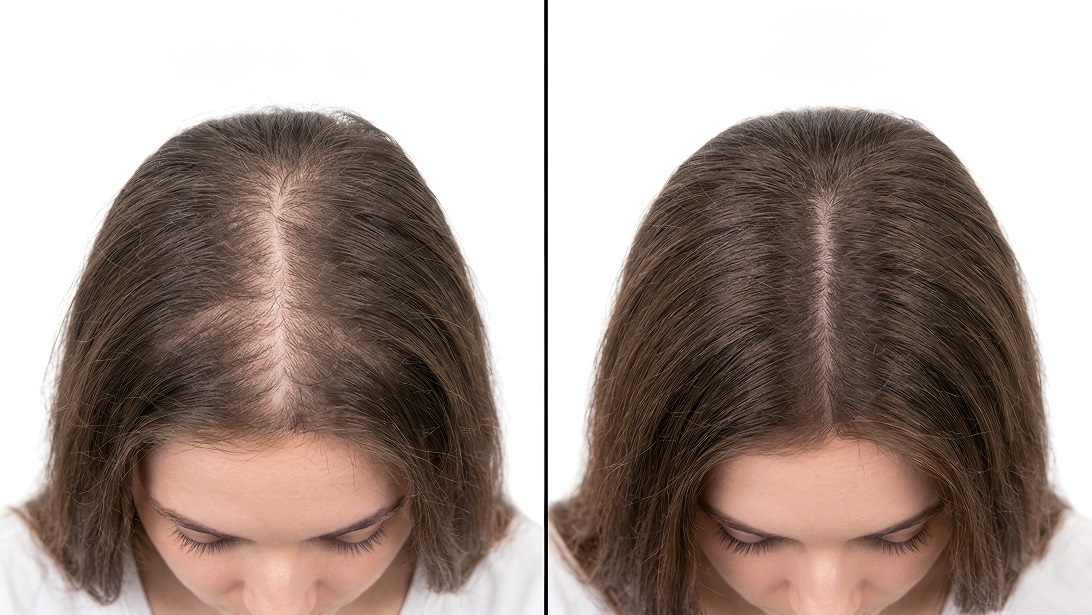 Minoxidil doustny w leczeniu wypadania włosów